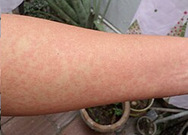 Brote de chikungunya en China obliga a tomar medidas similares al Covid
