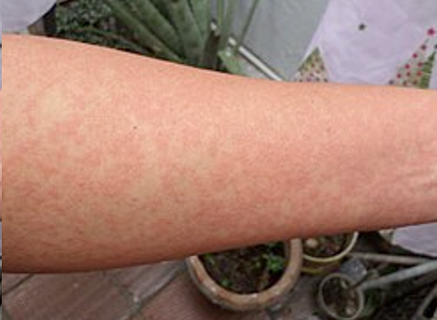Brote de chikungunya en China obliga a tomar medidas similares al Covid